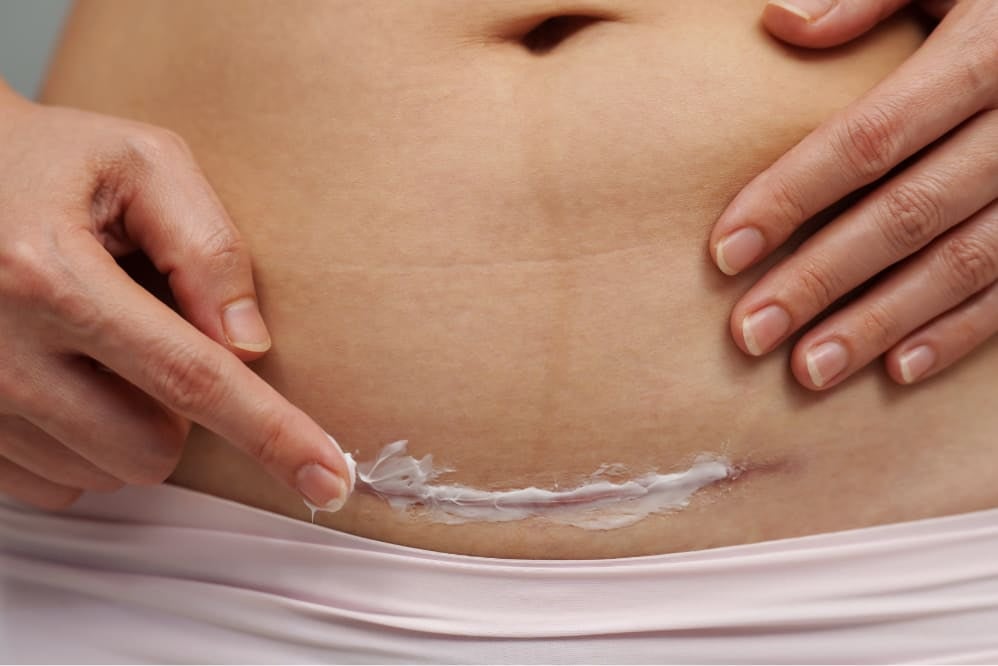Person applying scar cream to a healing C-section scar on the lower abdomen during postnatal recovery.