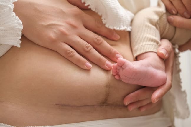 Postpartum recovery after a C-section, showing a healing surgical scar on a mother's lower abdomen while holding her baby